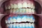 Teeth Whitening