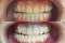 Teeth Whitening