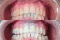 Teeth Whitening